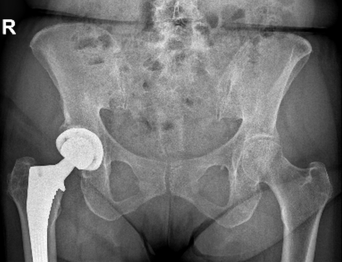 Elektromyografie medimalinas